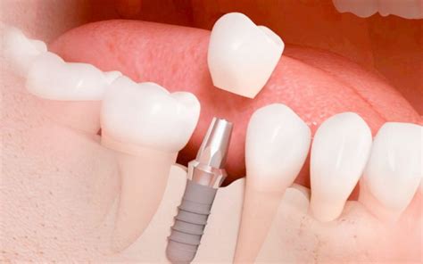 Periodo De Recuperaci N De Los Implantes Dentales Dentisalut