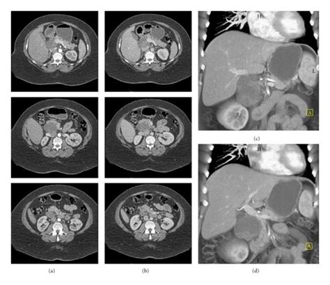 Abdominal Ct Scan With Iv Contrast Demonstrating A Cystic Mass In The