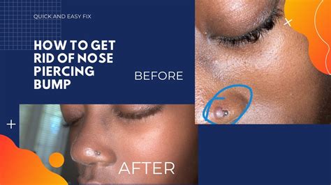 Get Rid Of Bumps On Nose Get Rid Of Bumps