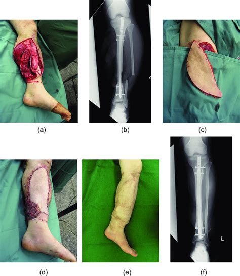 (a) An open fracture located in the distal third of the ...