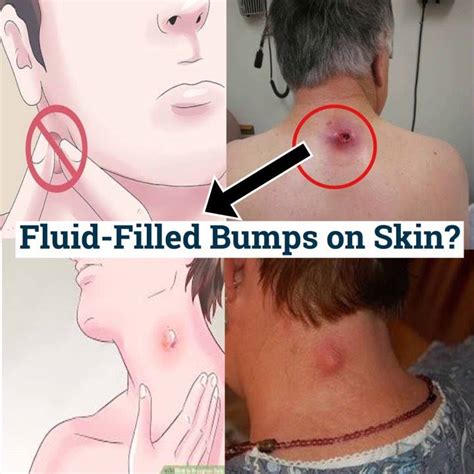 Do Not Ignore Fluid Filled Bumps On Skin Everything You Need To Know