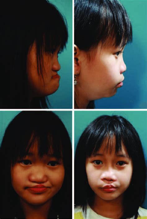 Patient With Unilateral Cleft Lip And Palate Before And After 30 Mm