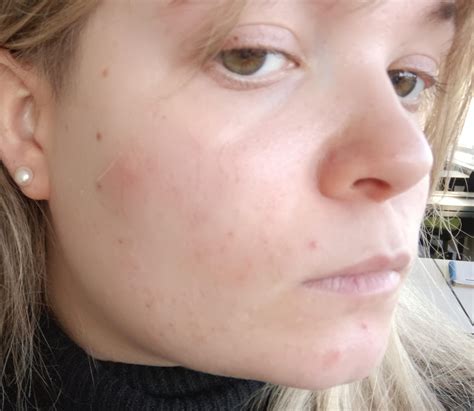 Picture Is This Keratosis Pilaris On My Face Skin Feels Rough But No