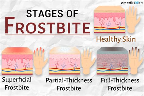 Frostbite Stages Prevention And Treatment Emedihealth
