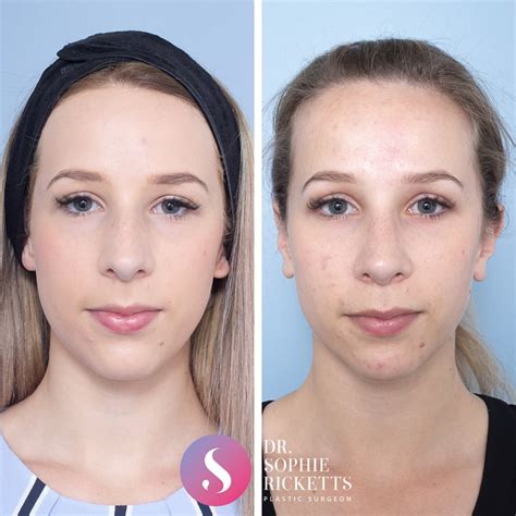 Rhinoplasty In Melbourne Plastic Surgery Procedure Dr Sophie Ricketts