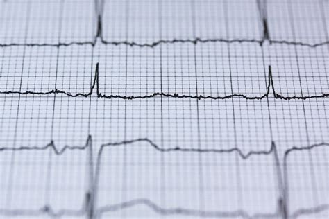 cardiomiopatie cauze simptome tratament dr max