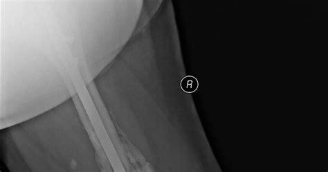 Tibia Fracture Recovery Fracture Treatment