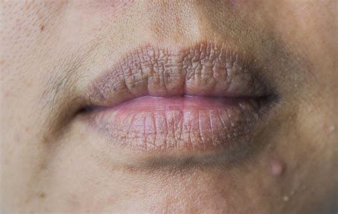 Dry Red Flaky Skin On Upper Lip