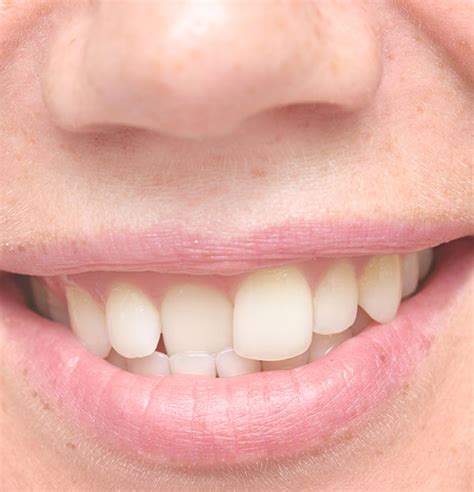 Crooked And Misaligned Teeth Treatment