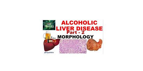 Alcoholic Liver Disease Morphology Clinical Features And Complications Pathology Made Simple