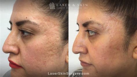 How To Treat Pitted Acne Scars And Boost Your Confidence Laser Ny