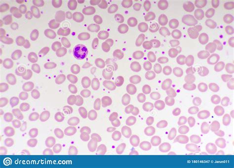 Blood Smear Anemia Patient Show Nrbc Medical Science Royalty Free Stock
