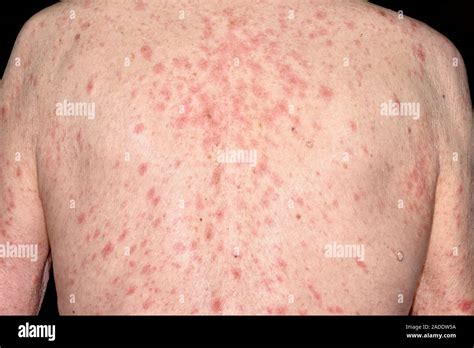 Drug Allergy Reaction Close Up Of A Rash On The Back Of A 91 Year Old