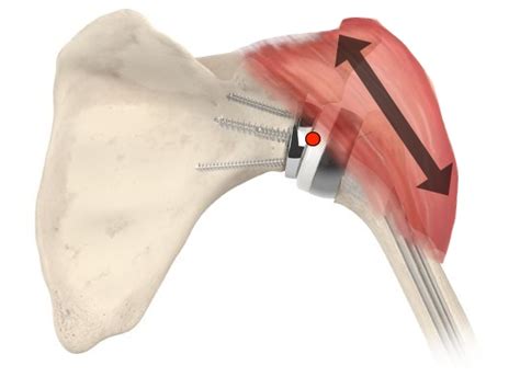 Reverse Shoulder Replacement What You Need To Know Shoulder And Elbow