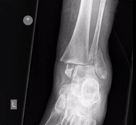Management Of Ankle Fractures The Bmj