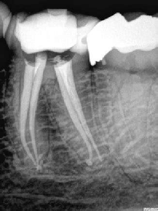 Two Rooted Left Mandibular First Permanent Molar With Four Canals Two