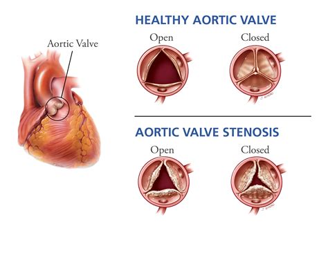 Heartbeat Improving Diagnosis And Management Of Aortic Valve Disease My Xxx Hot Girl