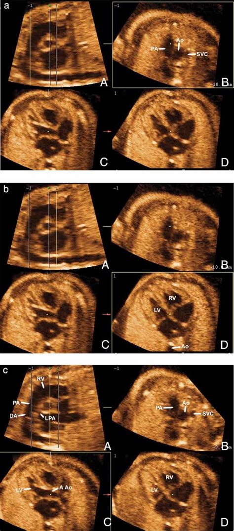 Standardized Views Of The Fetal Heart Using Four‐dimensional