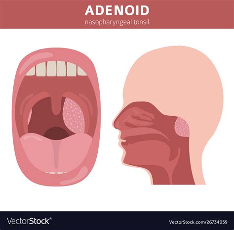 Nasal And Throat Nasopharynx Diseases Adenoids Vector Image