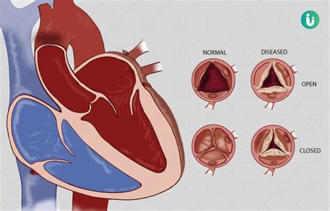 Rheumatic Heart Disease Symptoms Causes Treatment Medicine