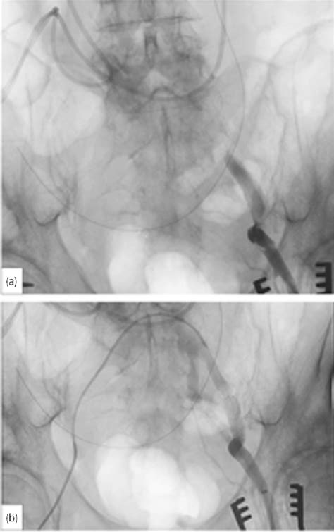 Figure 2 From External Iliac Arterial Dissection After Robotassisted