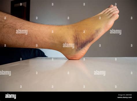 Right Foot Bruise Also Known As Contusion On A Large Area With Stock