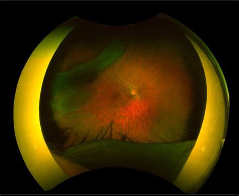 Giant Retinal Tear Detachment 135 Vitreoretinal Surgery