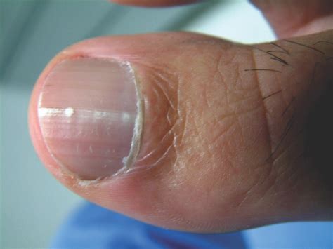 It can appear as a dark, vertical line and won't present any painful lesions or sensitive areas until it progresses. Nail Melanoma Symptoms - Bios Pics