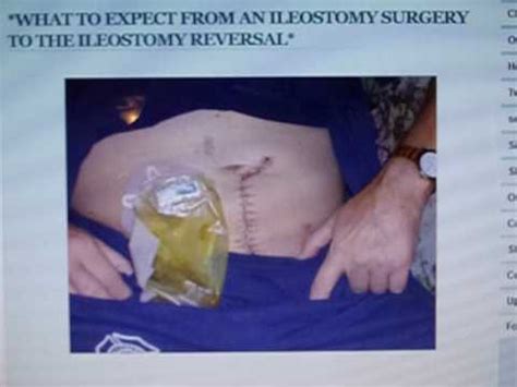 It is usually done after bowel surgery or injury. ILEOSTOMY REVERSAL SURGERY WHAT TO EXPECT...MY STORY - YouTube