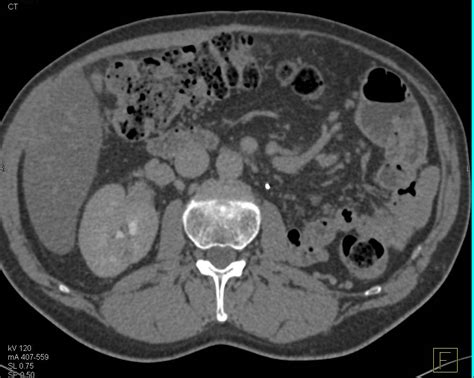 Renal Cell Carcinoma Metastatic To The Contralateral Adrenal Adrenal
