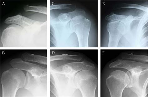 Figure 7 From Anatomic Coracoclavicular Ligament Reconstruction For The