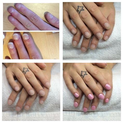 From Very Bitten Nails To Healthy Natural Nails In Months Helped By