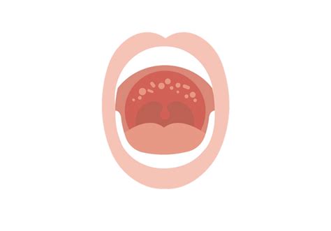 Pain And Sore Roof Of Mouth 4 Causes And Treatments