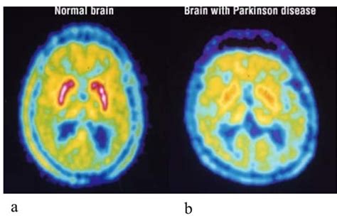 Pet Scans Of A A Normal Brain And B Brain With