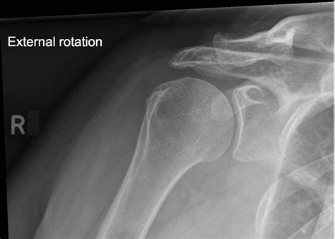 This is usually the result of one falling on an. Normal shoulder | Image | Radiopaedia.org