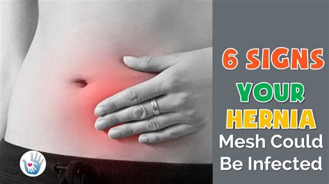 6 Signs Your Hernia Mesh Could Be Infected Youtube