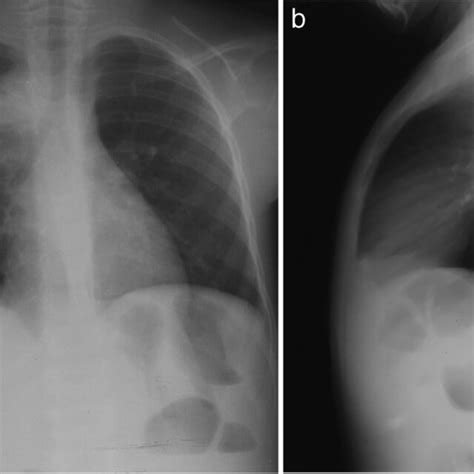 Anteroposterior A And Lateral B Chest Radiographs Of A 6 Year Old