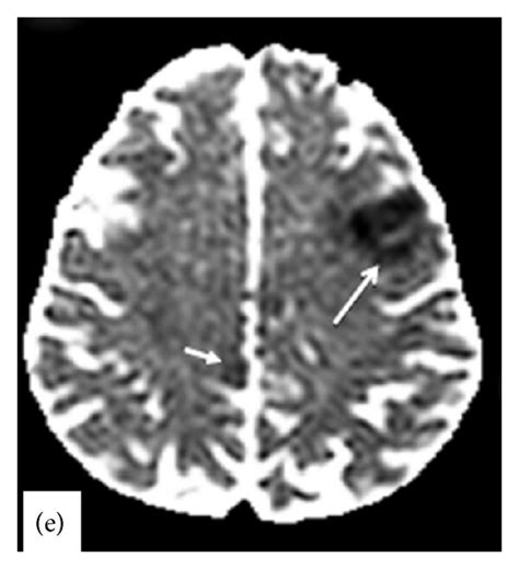 Representative Brain Mri Dwi Scans Of Patients With Multiple Acute
