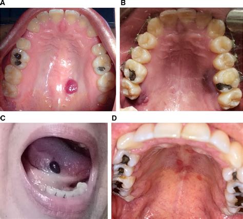 Oral Mucosal Lesions In Patients With Sars‐cov‐2 Infection Report Of