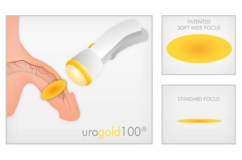 Urogold 100 Shockwave Therapy Uci Mens Health Male Infertility And Erectile Dysfunction