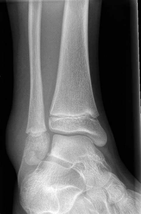 Fractures Ankle