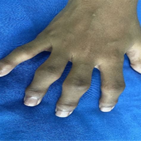 Swelling Of The Proximal And Distal Interphalangeal Joints Of The Right