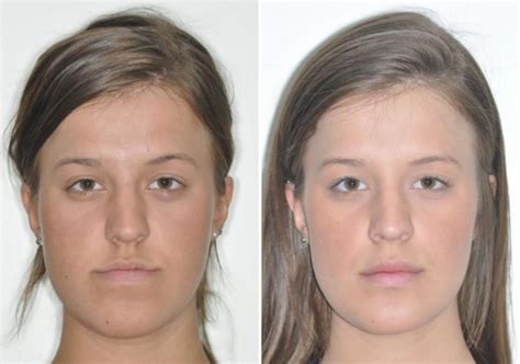 Case 6 Upper And Lower Jaw Surgery Sydney Oral And Facial Surgery