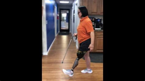 Sarah An Above The Knee Amputee Walking Post Surgery Youtube