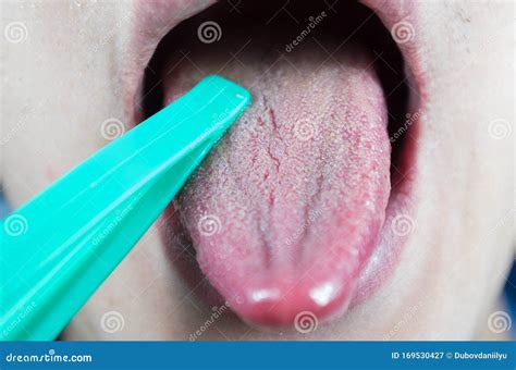 examination of the patient`s tongue tongue disease exam of the dentist stock image image of