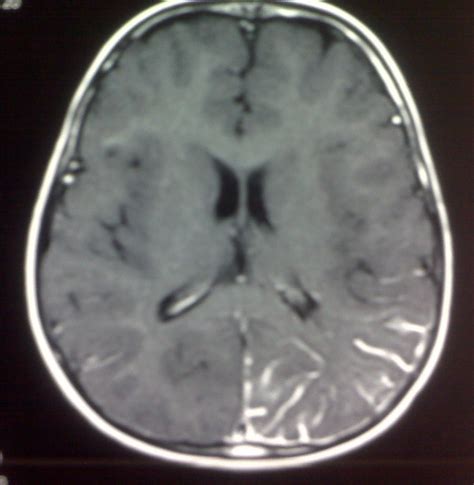 Sturge Weber Syndrome Mri Sumers Radiology Blog