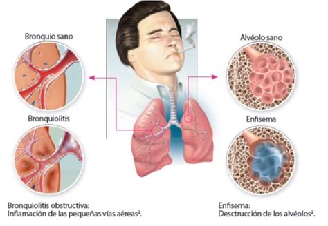 Bronquiolitis Qu Es S Ntomas Causas Tratamientos Y M S