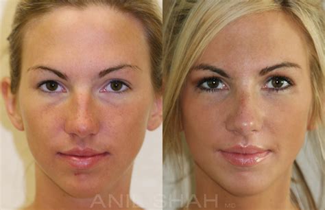 Rhinoplasty Pictures Chicago Il Patient 481