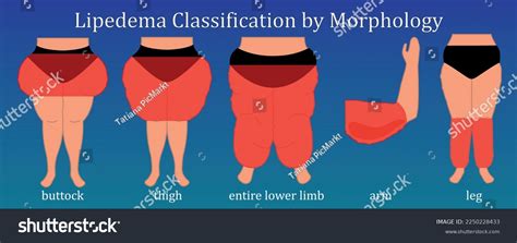 Classification Lipedema By Morphology Red Accent Stock Vector Royalty
