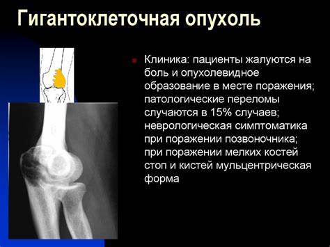 Заболевания костей диета Опухолеподобные заболевания костей. Дифференциальная диагностика Опухолеподобные заболевания костей. Дифференциальная диагностика Заболевания костей диета
